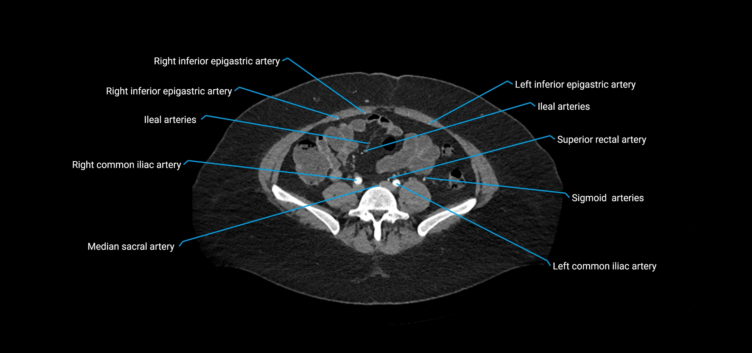 CTA abdomen axial cross sectional anatomy labelled image_161 (2).webp
